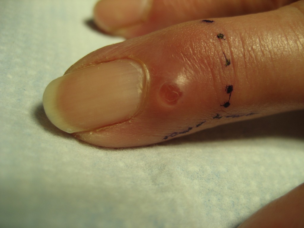 Mucous Cyst In Finger