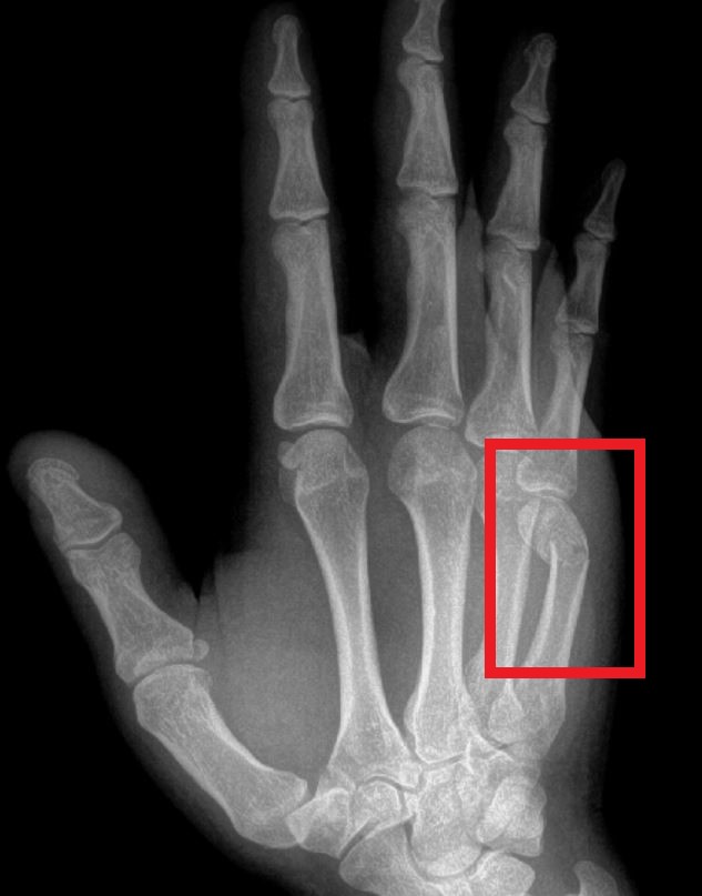 What is a boxer's fracture? - John Erickson, MD