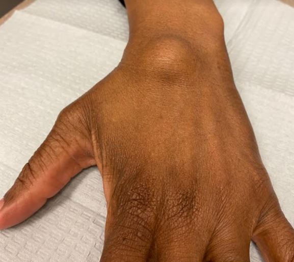 Lumps And Bumps And Cysts Of The Hand