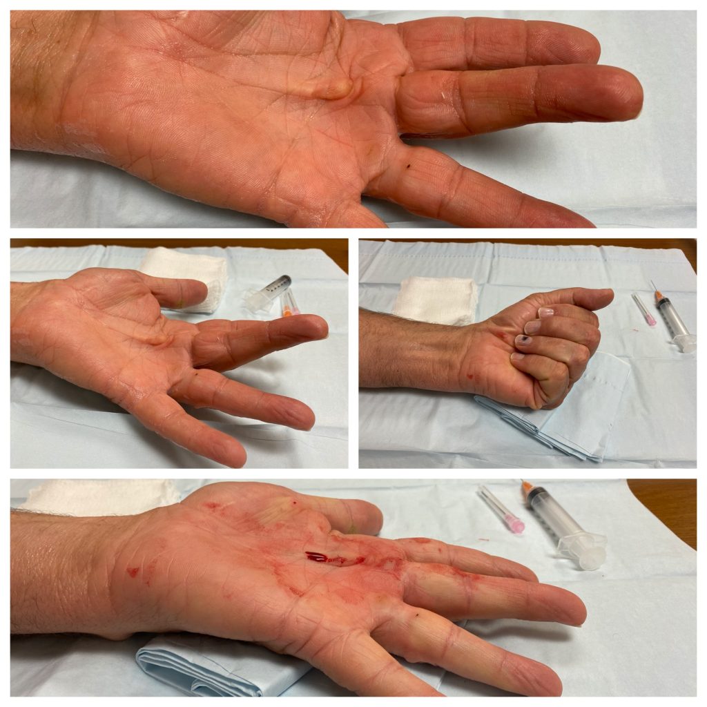 Needle Aponeurotomy for Dupuytrens Contracture