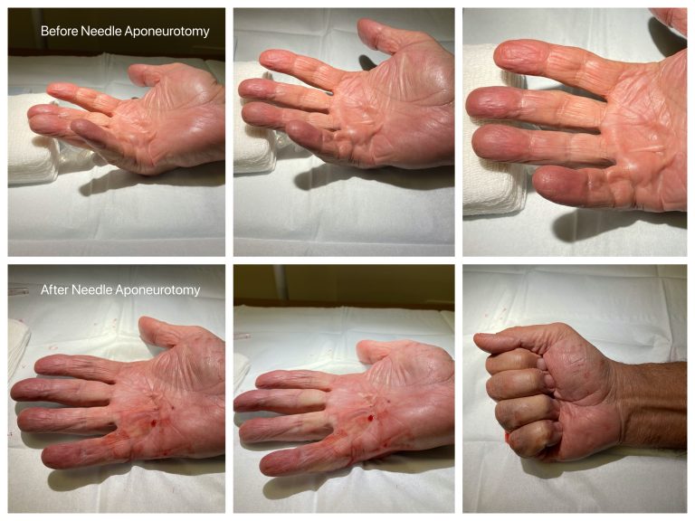 Dupuytrens Contracture Treatment by Dr Erickson in Raleigh