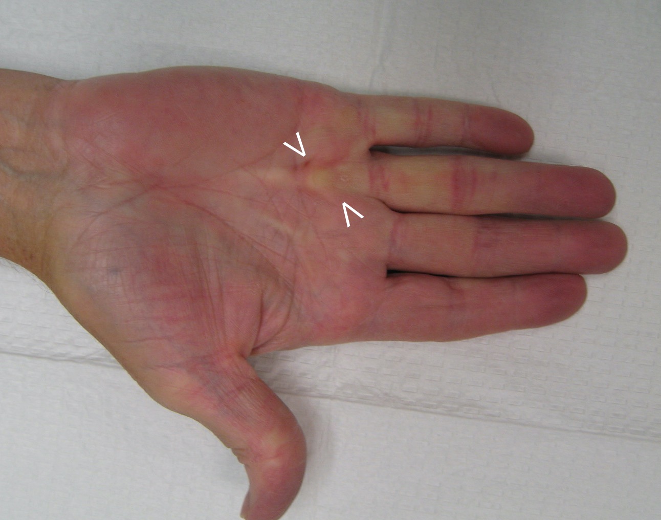 vikings disease dupuytens contracture