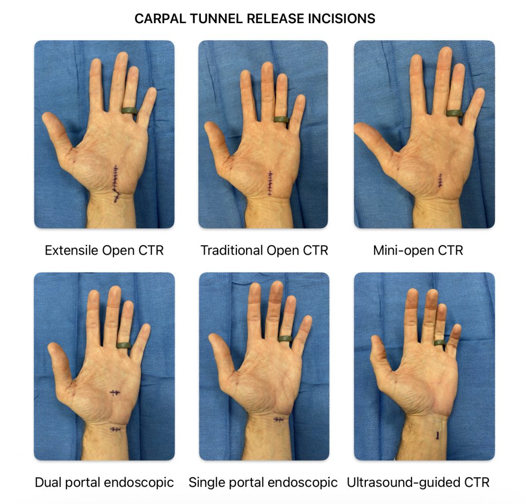 carpal tunnel release incisions