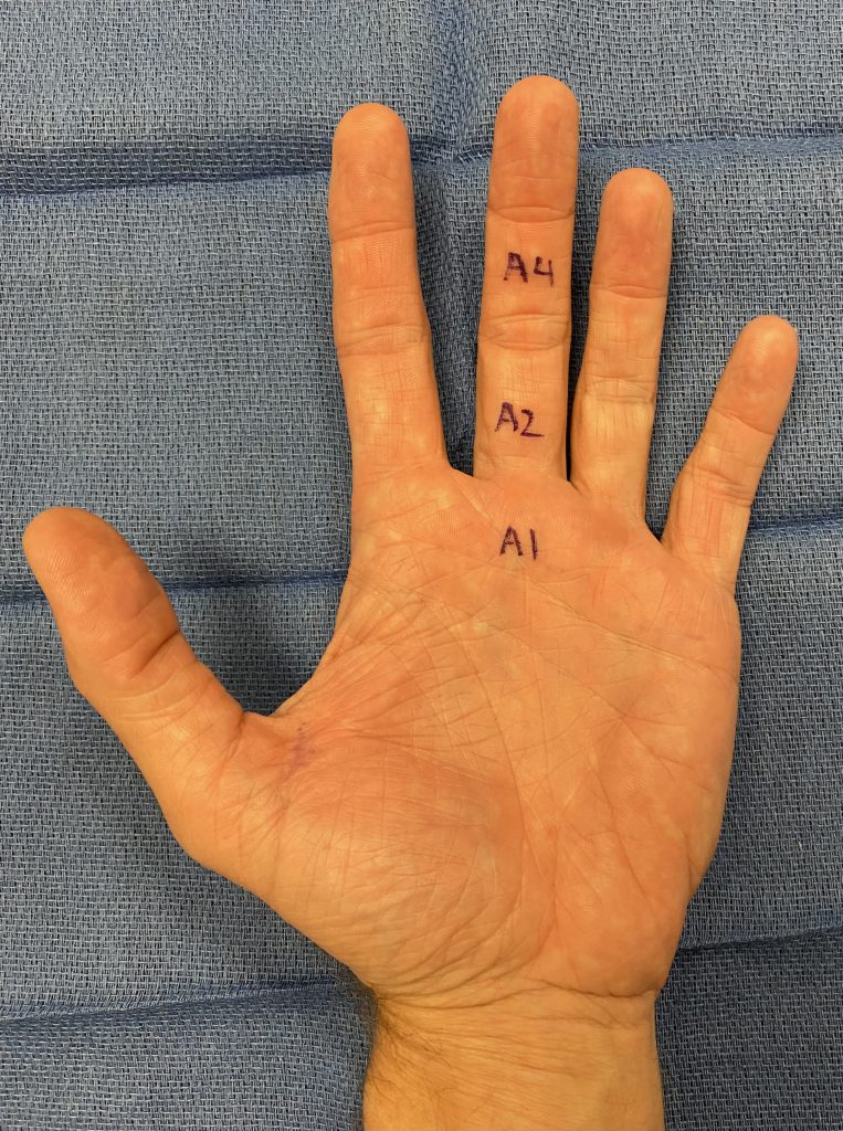 flexor tendon pulleys