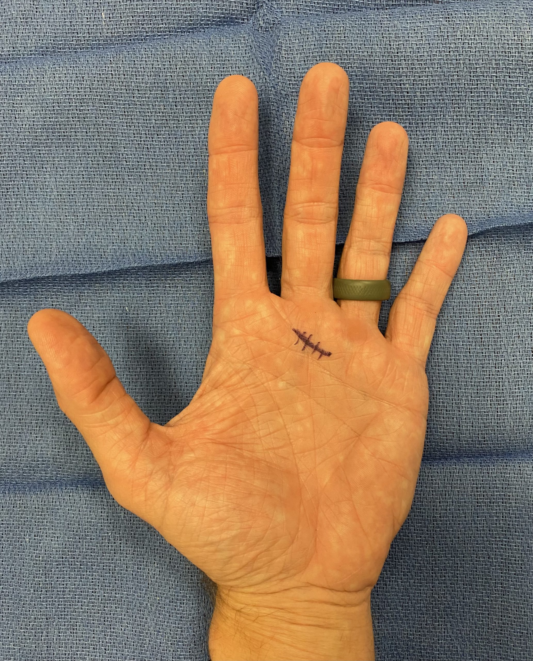 Trigger Finger Trigger Finger Surgery Dr Mark Gittos Plastic Surgeon