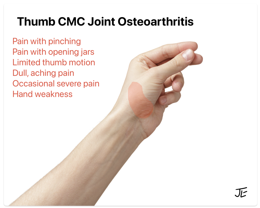 thumb CMC arthritis