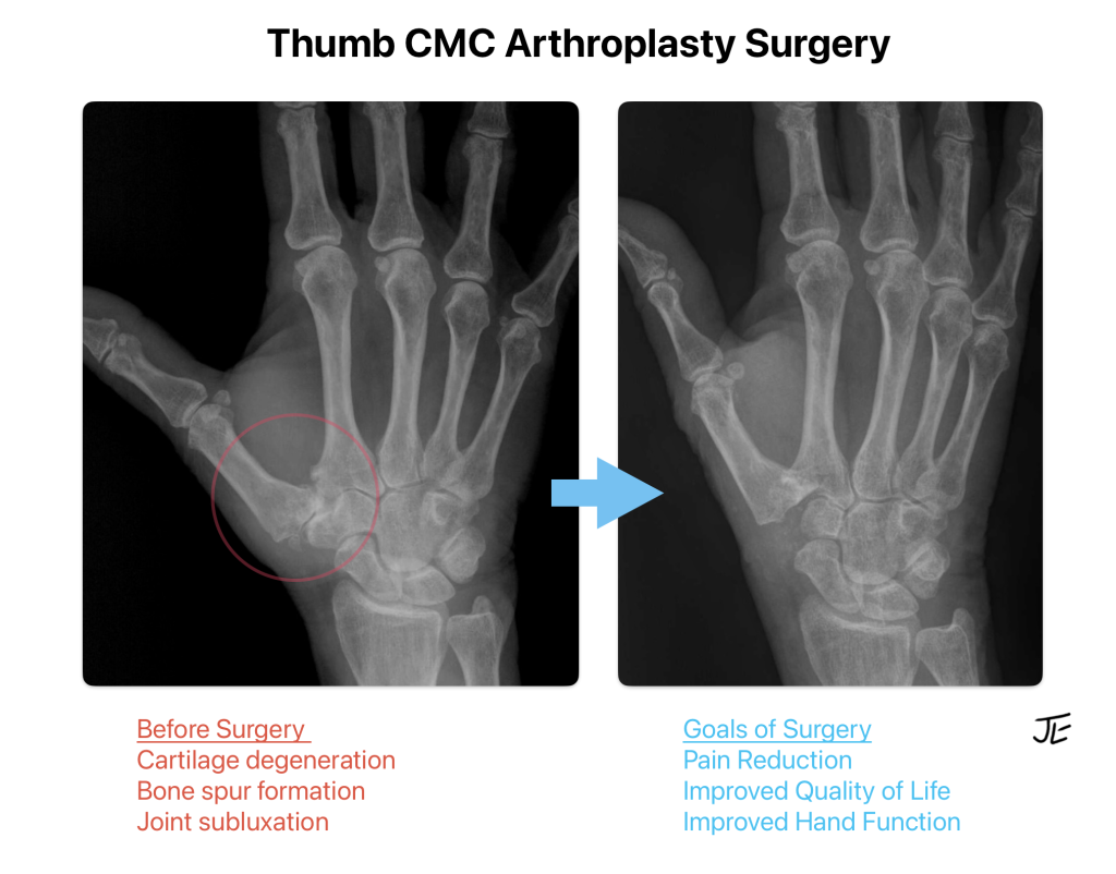 What Is The Best Thumb Arthritis Surgery John Erickson MD
