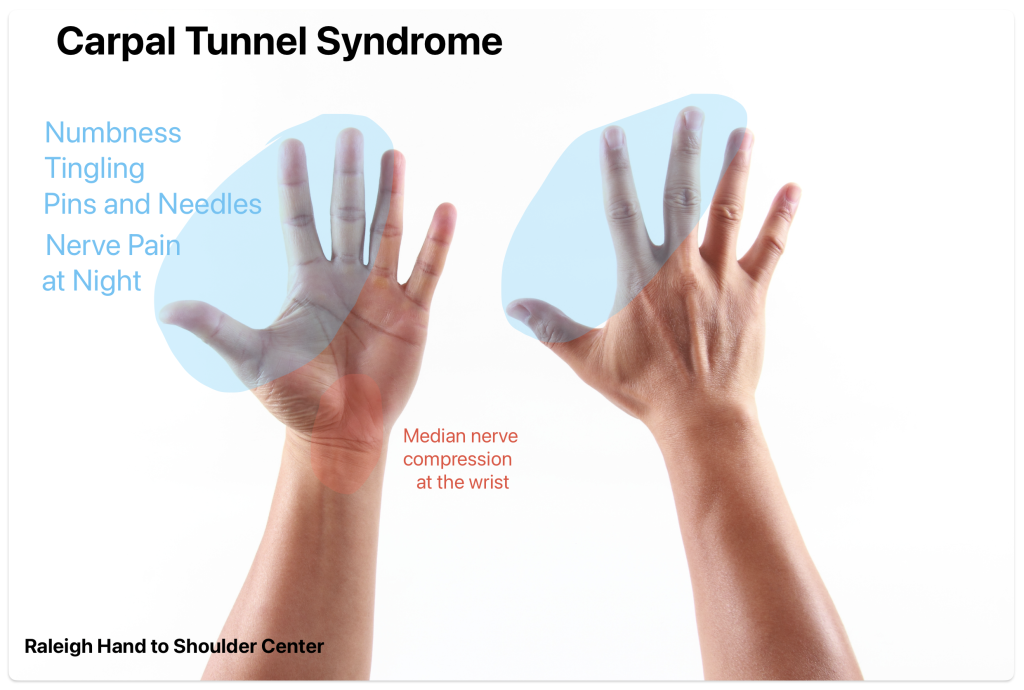 carpal tunnel syndrome symptoms