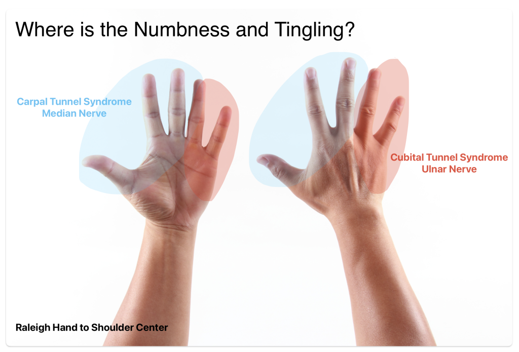 carpal tunnel and cubital tunnel
