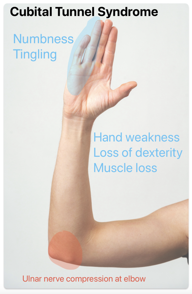cubital tunnel syndromes