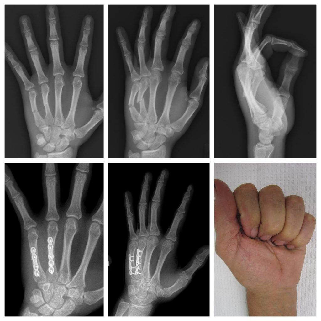 metacarpal fracture plate and screws