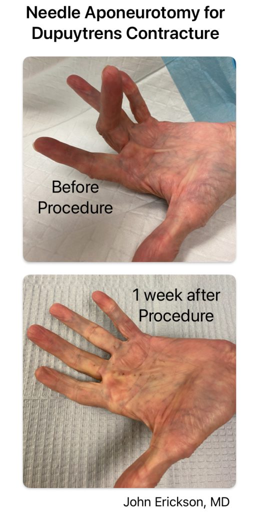 needle aponeurotomy for Dupuytrens