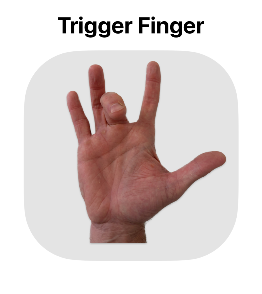 trigger finger