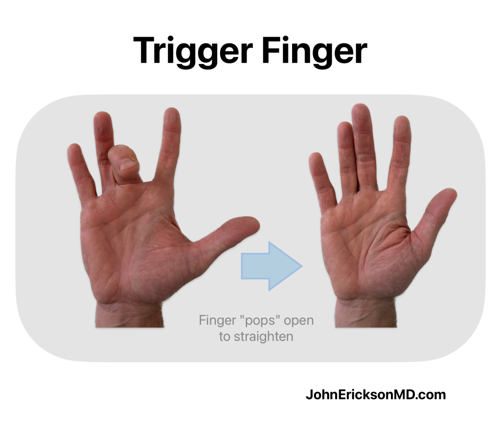 trigger finger symptoms