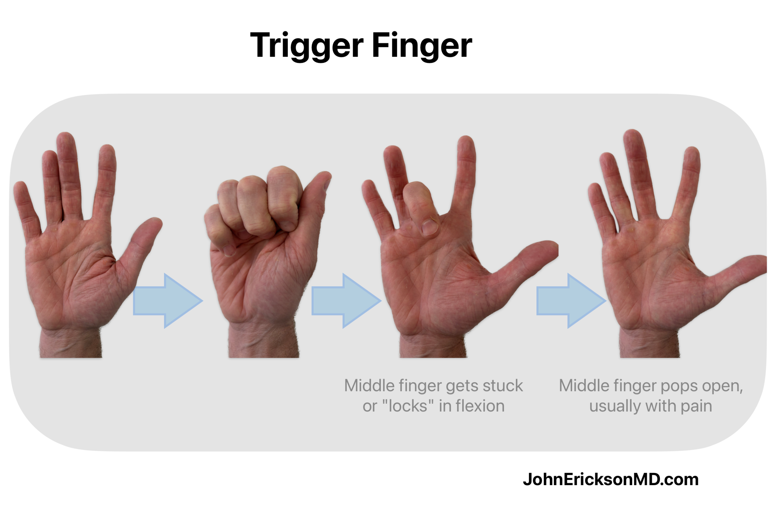 trigger finger catch pop and gets stuck